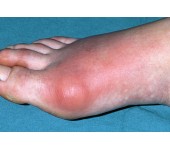 BỆNH GOUT (GÚT) CÁCH ĐIỀU TRỊ VÀ PHÒNG BỆNH